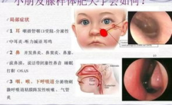 腺样体肥大有什么症状?,儿童健康警示