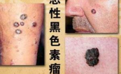 恶性黑色素瘤症状,早期识别与预防关键