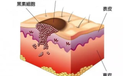恶性黑色素瘤症状,早期识别与预防关键