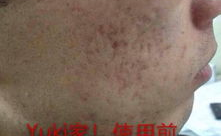 男生器官上长了痘痘是因为什么,揭秘男性生殖器痘痘成因与防治策略