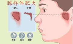 腺样体肥大有什么症状?,儿童健康警示